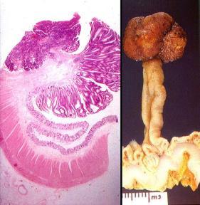 Polyps and Colon Cancer http://www.