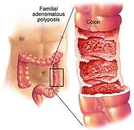 Polyps and Colon Cancer http://www.mayoclinic.