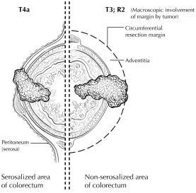 T3 R2 (right side) shows macroscopic involvement of the circumferential resection margin of a