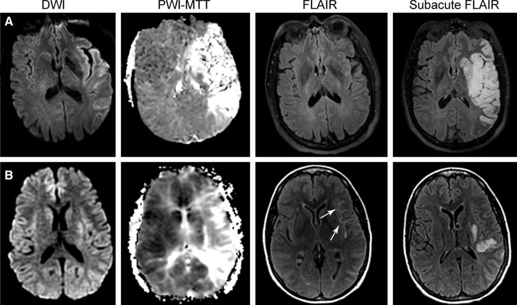 Figure 2 Representative cases of different grade distal hyperintense vessels (HV) (A) Initial diffusion- and perfusion-weighted MRI shows large left middle cerebral artery ischemic and perfusion