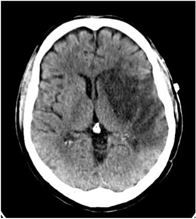 ACUTE INFARCTS: DWI diffusion weighted imaging Conventional MRI