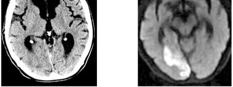 Left hemianopsia White Matter Diseases Microvascular Ischemic Disease Primary Demyelinating diseases Multiple Sclerosis Secondary demyelinating diseases Infectious