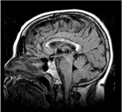 clinical courses and disease patterns Periventricular white matter, internal capsule, CC,