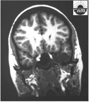 Case #8 Post-contrast DNET low grade tumor Dysembryoplastic Neuroepithelial Tumor (DNT) benign tumor associated