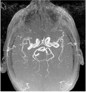MRA MRA Brain MR angiogram does not require contrast injection delineates