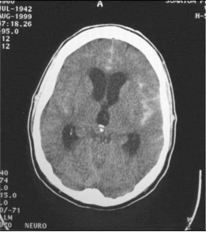 Subarachnoid Hemorrhage Traumatic SAH Most common cause Non-trauma SAH Rupture of intracranial aneurysm