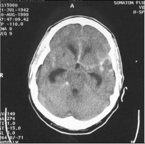 presentation Worst headache of the person s life CT is test of choice If CT is positive (and no other cause is