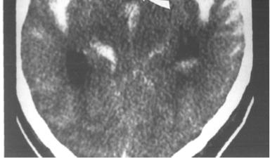 If CT is negative, an LP may be performed next to look for xanthocromia MR is relatively less sensitive/obvious