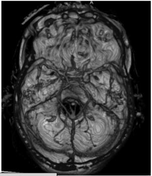 CT Angiogram using Intravenous iodinated contrast Stroke Stroke is the third leading cause of death in the USA. Each year 750,000 new patients are diagnosed resulting in > 200,000 deaths/year.