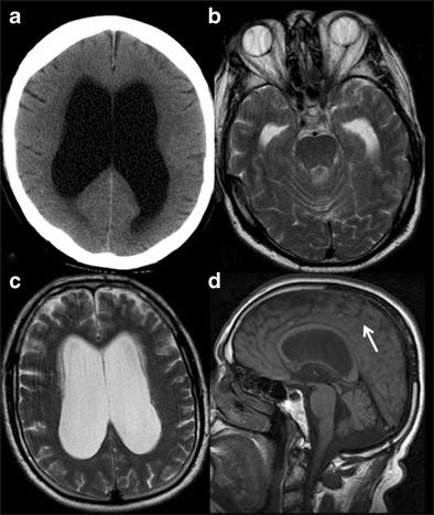 Normal pressure hydrocephalus Due to impaired absorption of CSF Can be secondary to
