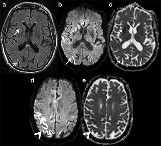 CJD. A. FLAIR with hyperintensity in caudate head and putamen as well as occipital cortex. B/C.