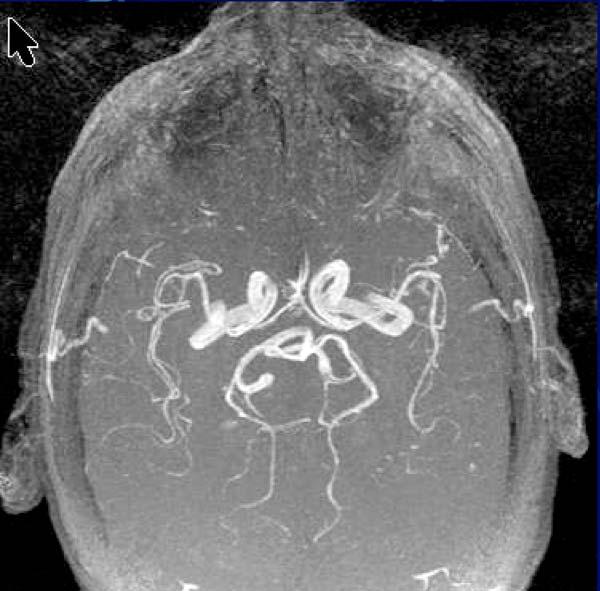 MRA Brain MR angiogram does not require contrast injection delineates circle of Willis