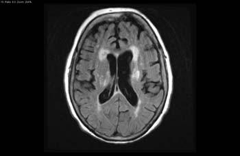 Microvascular ischemic disease Common in elderly; may not correlate with neurological deficits Part of normal aging?