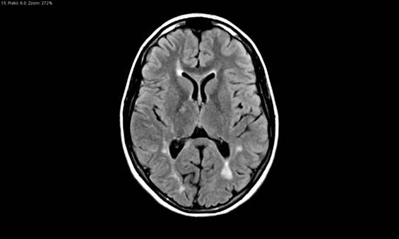 MS Variety of clinical courses and disease patterns Periventricular white matter, internal capsule, CC, pons, and brachium pontis Subcortical U fibers Gray matter
