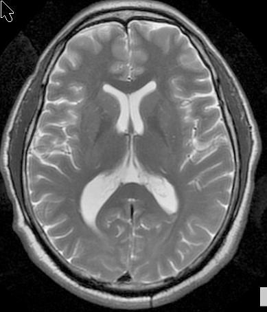 Brain MR axial T2 CSF