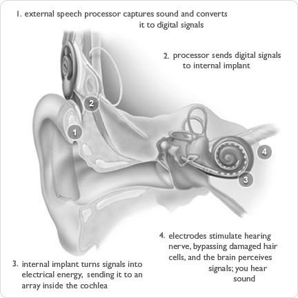 Figure 14. Illustration of how the cochlear implant restores the sensation of hearing for the severely to profoundly impaired ear. (courtesy of Cochlear Limited, Sydney, Australia).