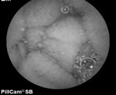 Preliminary experience with double-balloon balloon enteroscopy unexplained digestive bleeding (chronic anemia of strict degree)