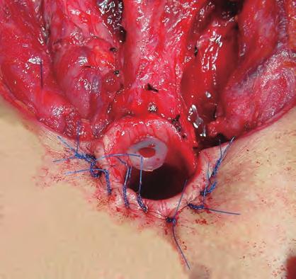 Wound Closure and Fashion the Stoma just below a tracheal ring. The suture is then passed back through the skin from subcutaneous to external, just horizontal to the initial entry point.