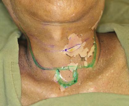 SM TH * Figure 1 Apron incision and the stoma