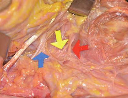 * * Figure 6 Hypoglossal nerve (blue arrow), superior