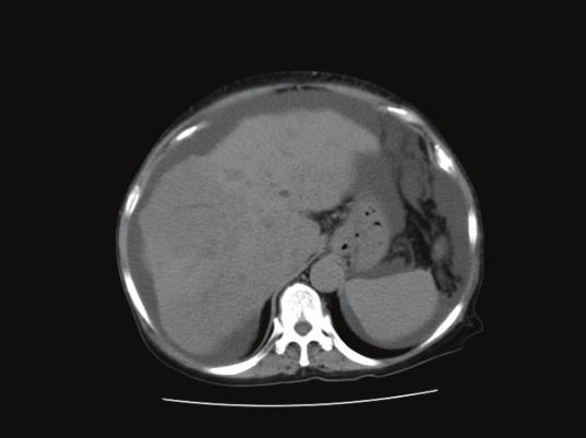 A Case of Advanced Multiple Hepatocellular Carcinomas with Portal Vein Tumor Thrombosis Successfully 161 In July 2008, acute peritonitis developed due to tumor invasion into the duodenum and the