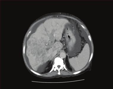 162 A Case of Advanced Multiple Hepatocellular Carcinomas with Portal Vein Tumor Thrombosis