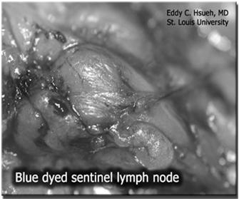 lymphadenectomy Superficial lymph nodes in the groin.