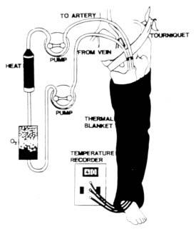 Technique of Isolated Limb ILP is a surgical procedure that involves controlling the