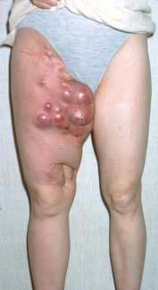 Case Report 32 y/o with distal thigh melanoma She failed melphalan ILP,