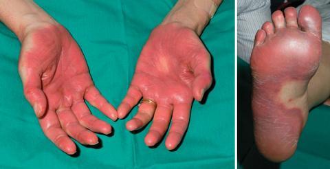 Trametinib side effects Skin toxicity (87%): Rash, dermatitis acneiform rash, palmar-plantar erythrodysesthesia syndrome (hand-foot syndrome-hfs), erythema, Diarrhea