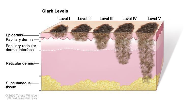 melanoma cells are throughout the papillary dermis and touching on the next layer down (the reticular dermis) Level 4 the