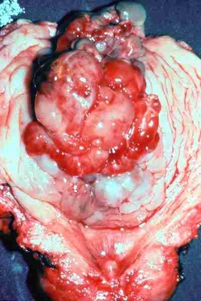 Sarcoma Botryoides Embryonal rhabdomyosarcoma Undifferentiated mesenchyme of vaginal lamina propria Grape-like masses Vaginal