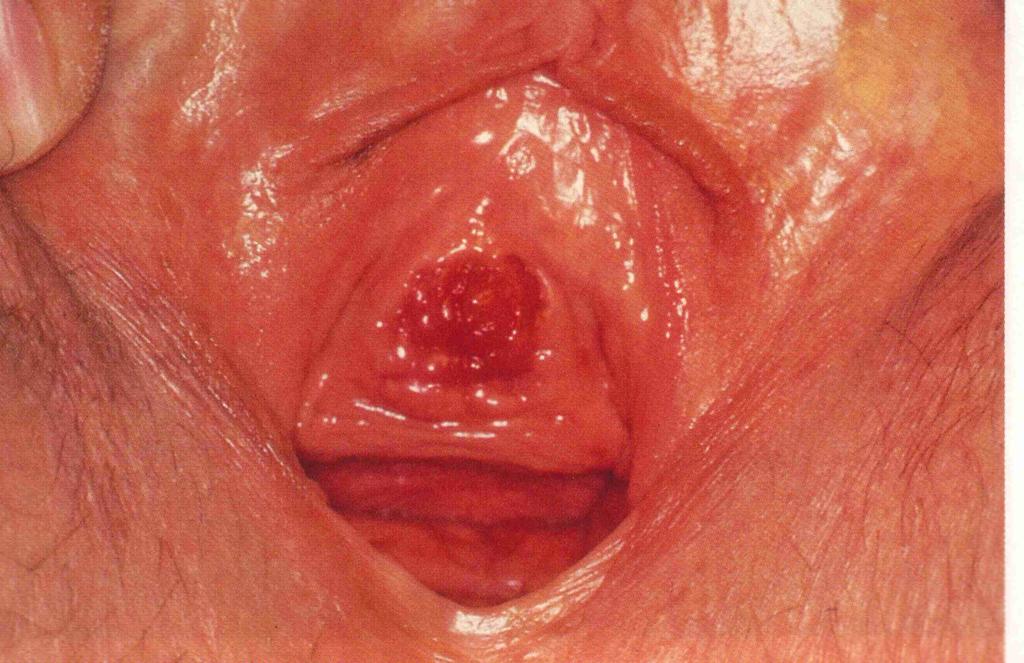 Urethral