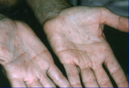 Evidence of infection with syphilis within the last