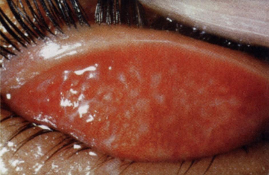 Clinical Syndrome -Trachoma From: G.