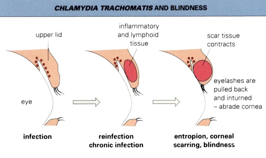 Clinical Syndrome -Trachoma (C.
