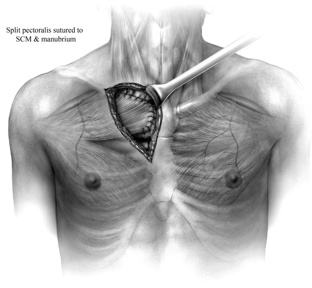 Surgical management of the infected sternoclavicular joint 51 Figure 10 The muscle flap is advanced into the defect and secured with interrupted absorbable suture to the sternocleidomastoid muscle.