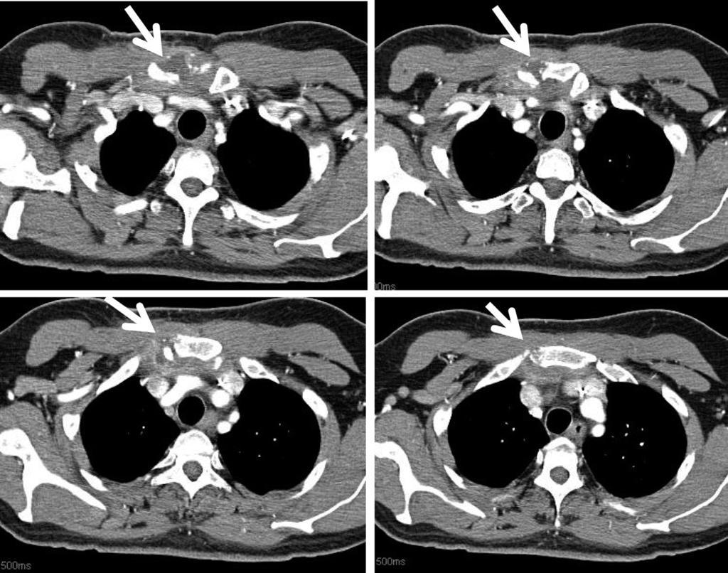 Surgical management of the infected sternoclavicular joint 43 Figure 2 Selective slices from CT image in a patient with