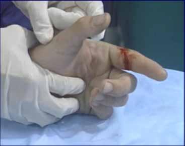 Hand/Finger Lacerations Common Injury Digital