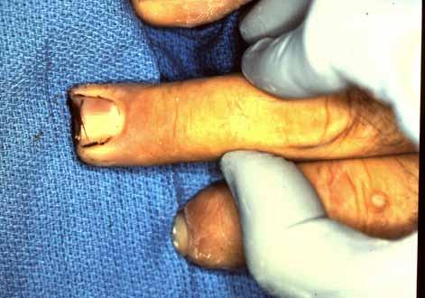 Fingertip Amputations Abx, tetanus, I&D Soft