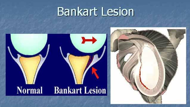 Shoulder Dislocations Associated Injuries Bankart tear Hill Sach s