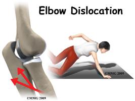 Elbow Dislocations 2 nd most common large joint