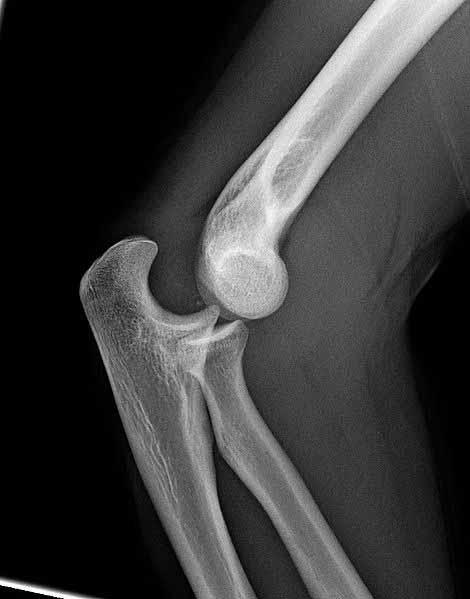 Elbow Simple: dislocation without Fracture Complex: