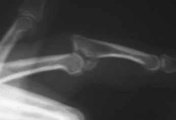 PIP Dislocations Fracture dislocations