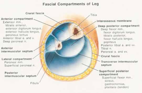 Compartment Syndrome Anatomy of leg: 4 compartments