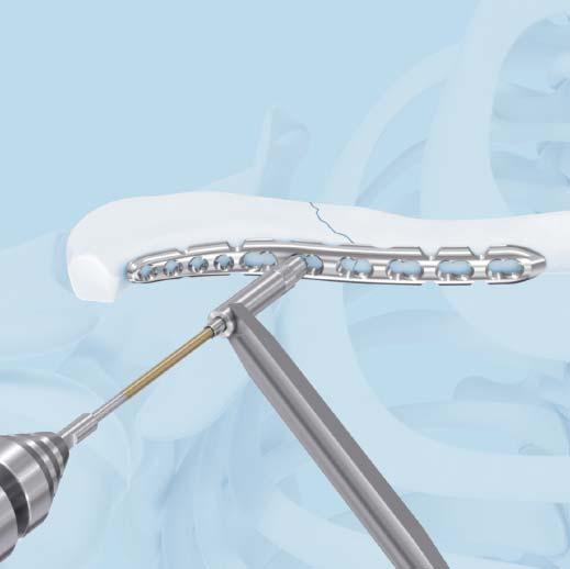 7 Insert screws Determine the combination of screws to be used for fixation.