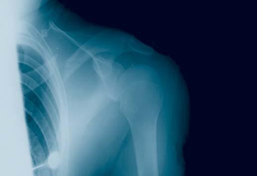 nonunions, and osteotomies of the clavicle in adults, and in both adolescents (12 18 years) and