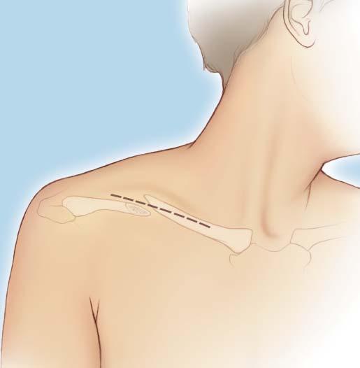 Surgical Technique 2 Approach The horizontal incision is placed over the superior or inferior clavicle, depending on the stabilization method.