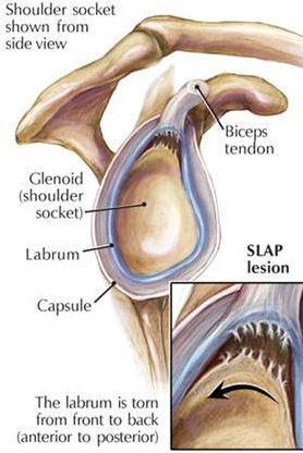 Can be acute or chronic Most common are SLAP tears superior labrum anterior to