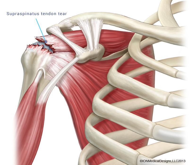 Usually older patients with underlying shoulder complaints who have additional acute injury Pain with sleeping on